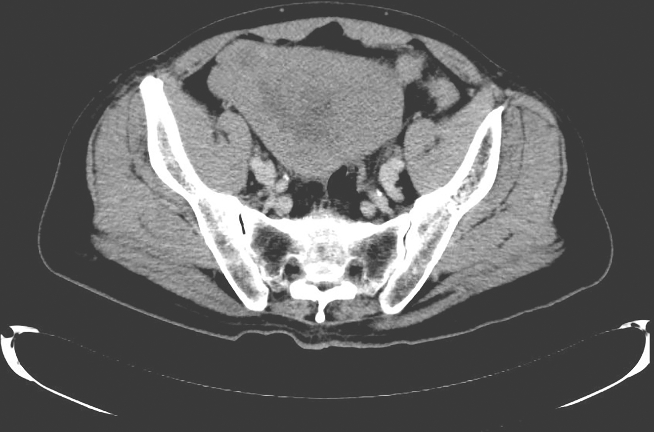 图3 服用伊马替尼4个月后复查腹盆腔增强CT.jpg